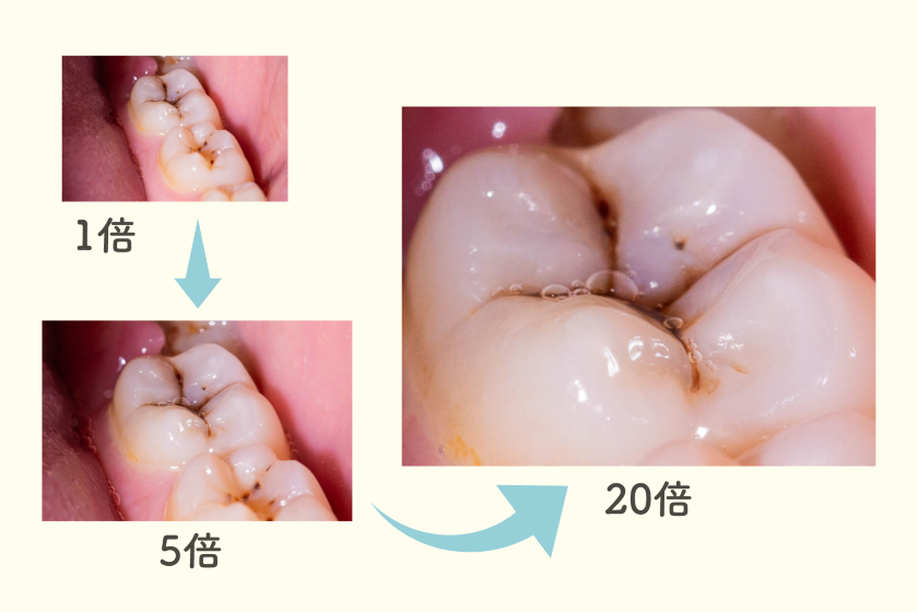 むし歯・歯周病の早期発見